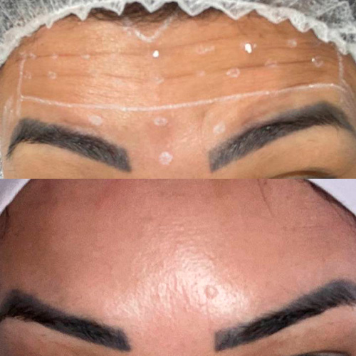 Resultado de tratamento 3