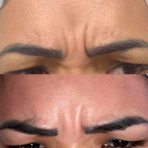 Resultado de tratamento 4