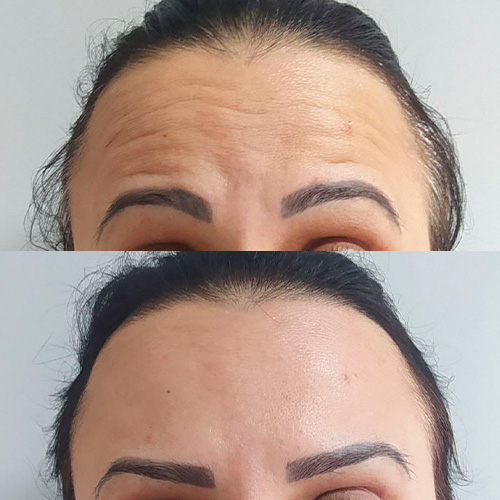 Resultado de tratamento 6